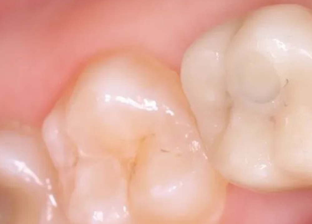 Отбеливание после лечения