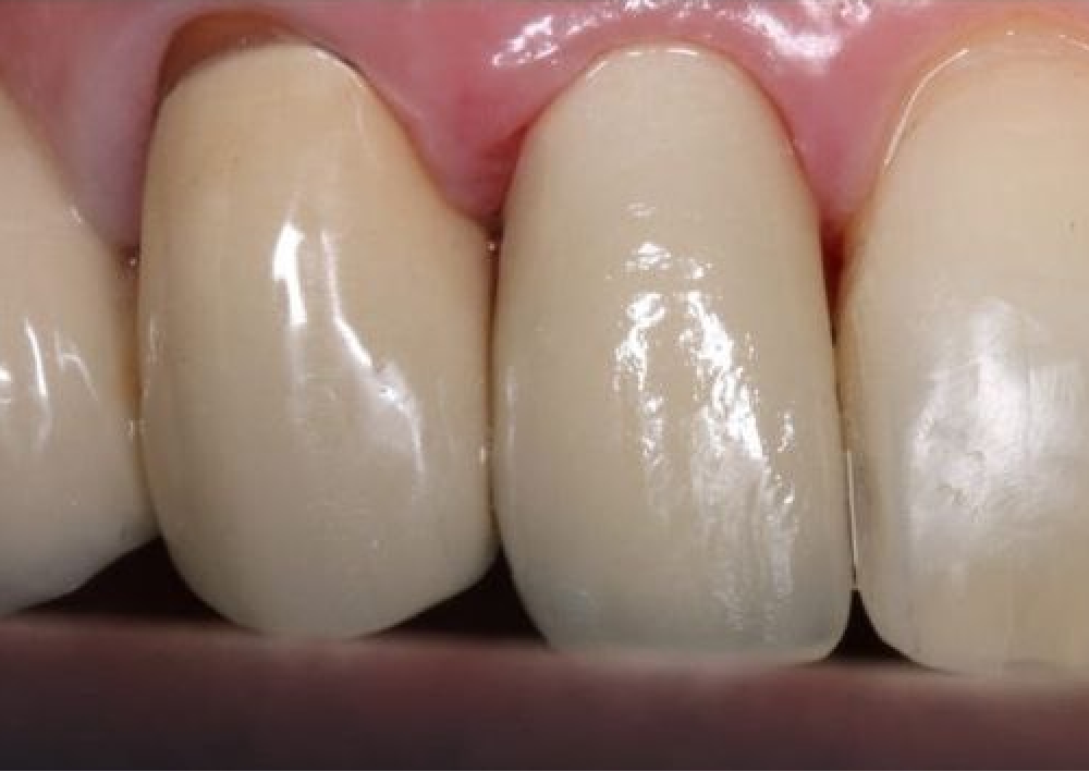 Эстетическая реставрация после лечения